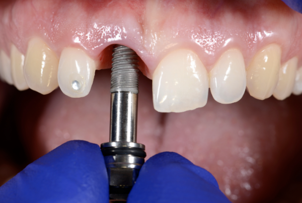 brenham tooth implant dental implant dental implants titanium tooth artificial tooth brenham